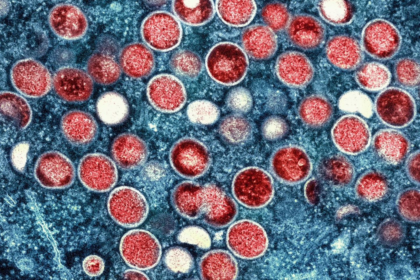 So sieht es unter dem Mikroskop aus: In der zentralafrikanischen Demokratischen Republik Kongo breitet sich das Mpox-Virus aus.