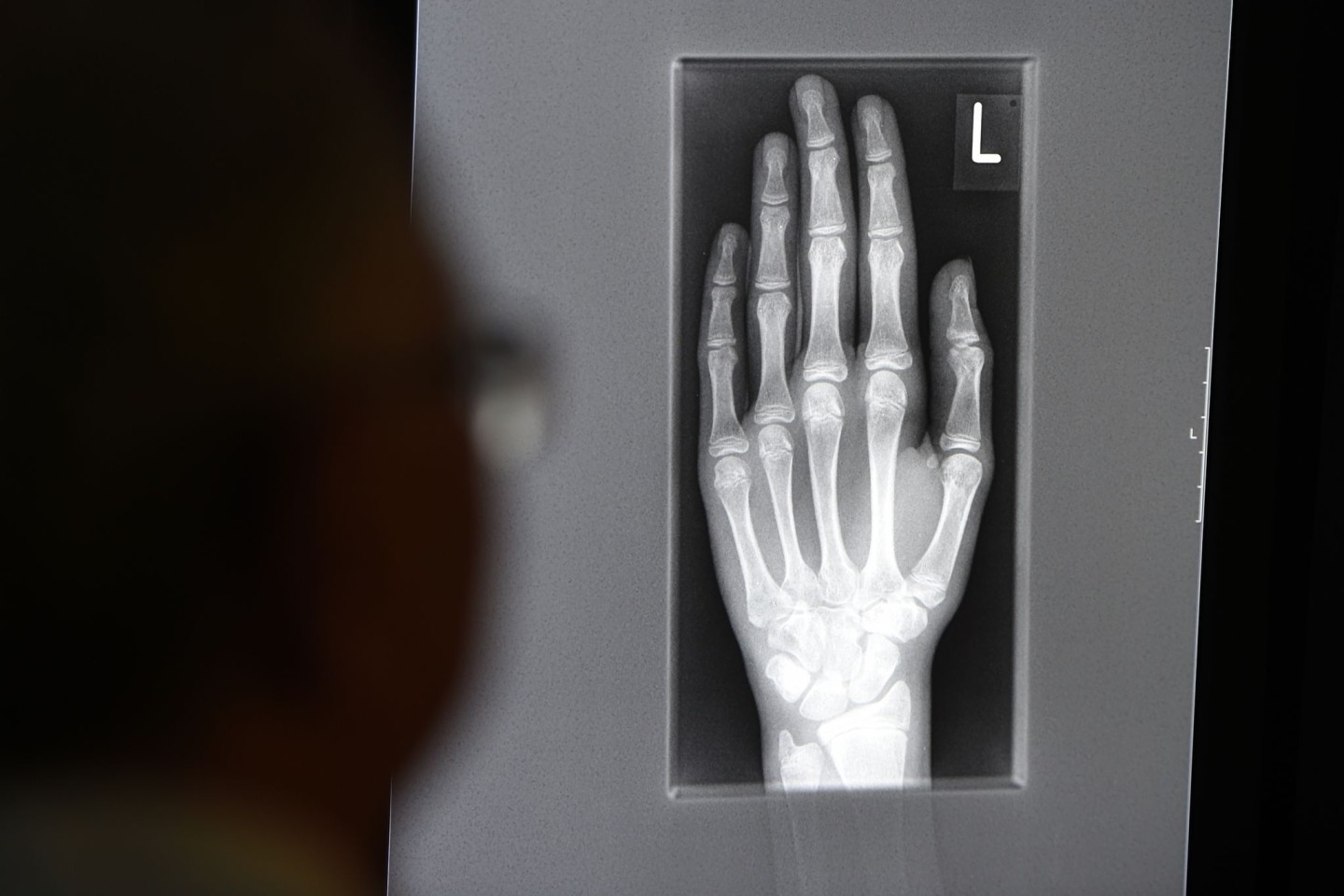 Ein Röntgenbild auf einem Bildschirm zeigt in einem Klinikum in Baden-Württemberg die linke Hand eines jungen Menschen im Alter zwischen 16 und 19 Jahren.