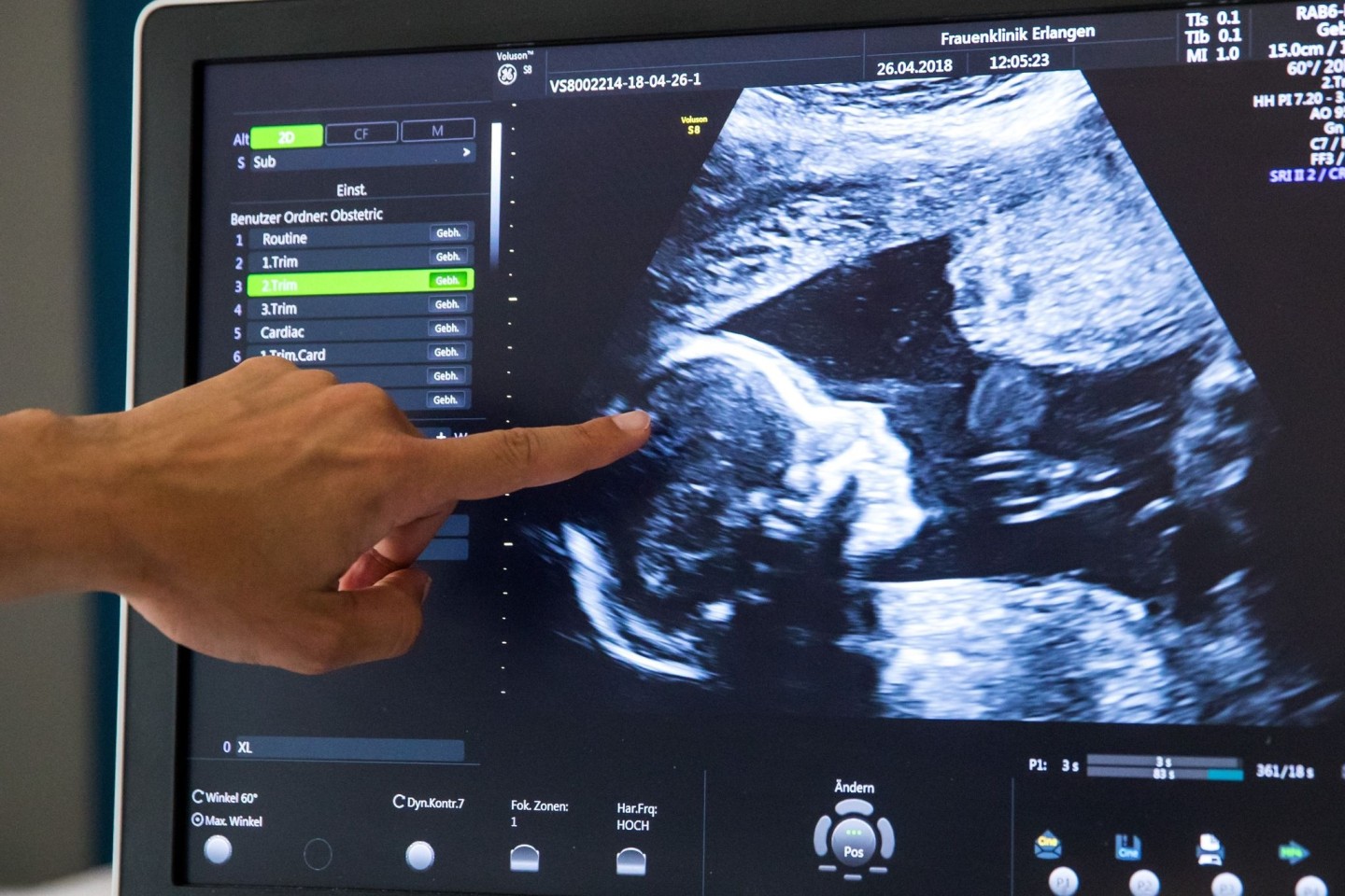 Während einer pränatalen Ultraschall-Untersuchung einer in der 18. Woche schwangeren Frau deutet ein Arzt auf den Kopf des Kindes.
