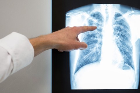 Tuberkulose-Fallzahlen in Deutschland leicht gestiegen