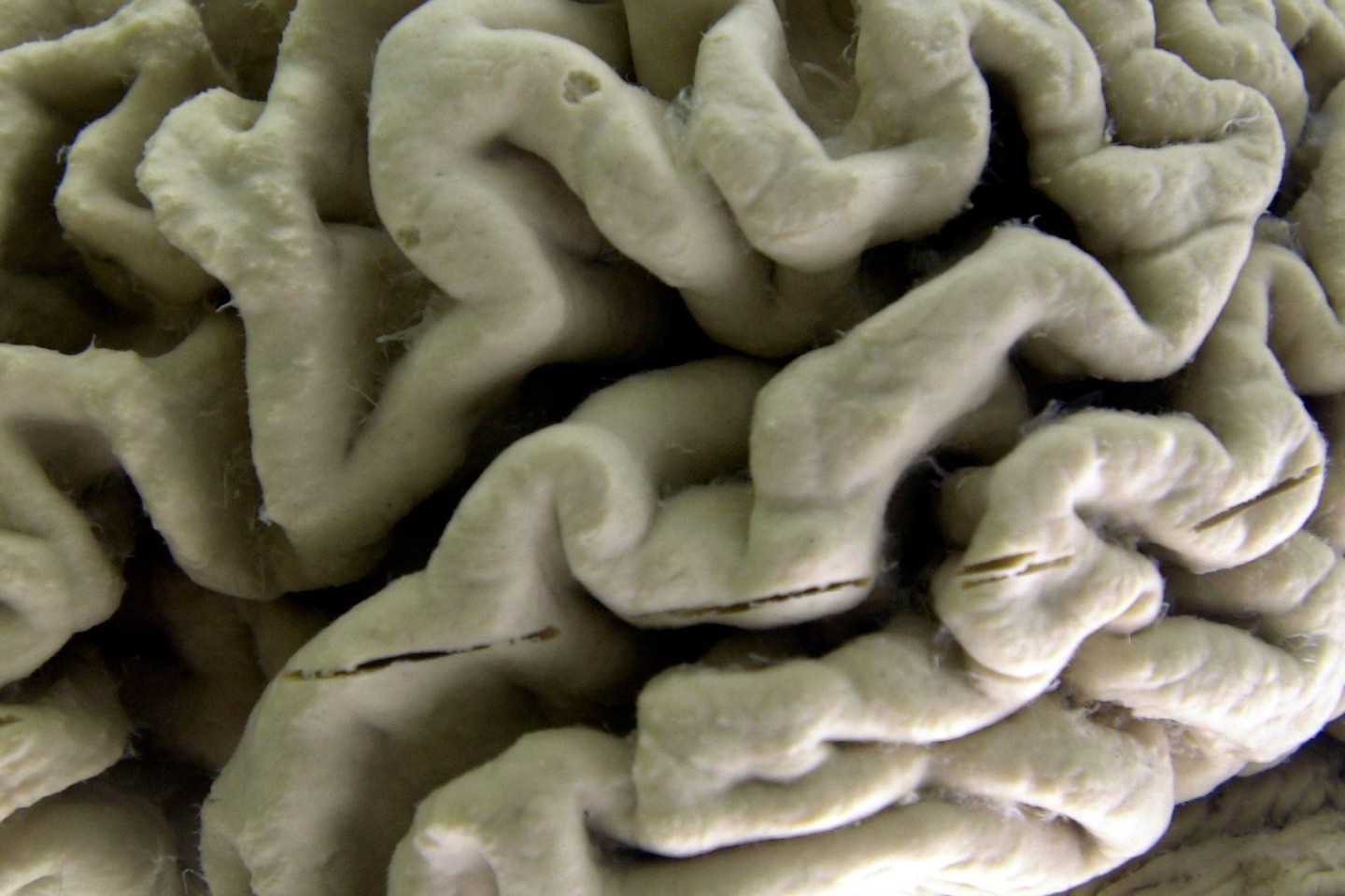 Eine Nahaufnahme eines menschlichen Gehirns, das von der Alzheimer-Krankheit betroffen ist, ausgestellt im Museum für Neuroanatomie an der University at Buffalo.